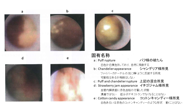 冠動脈内の内視鏡観察