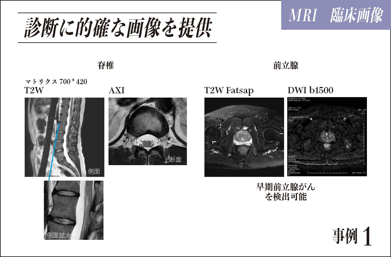 診断に的確な画像を提供 脊椎 前立腺