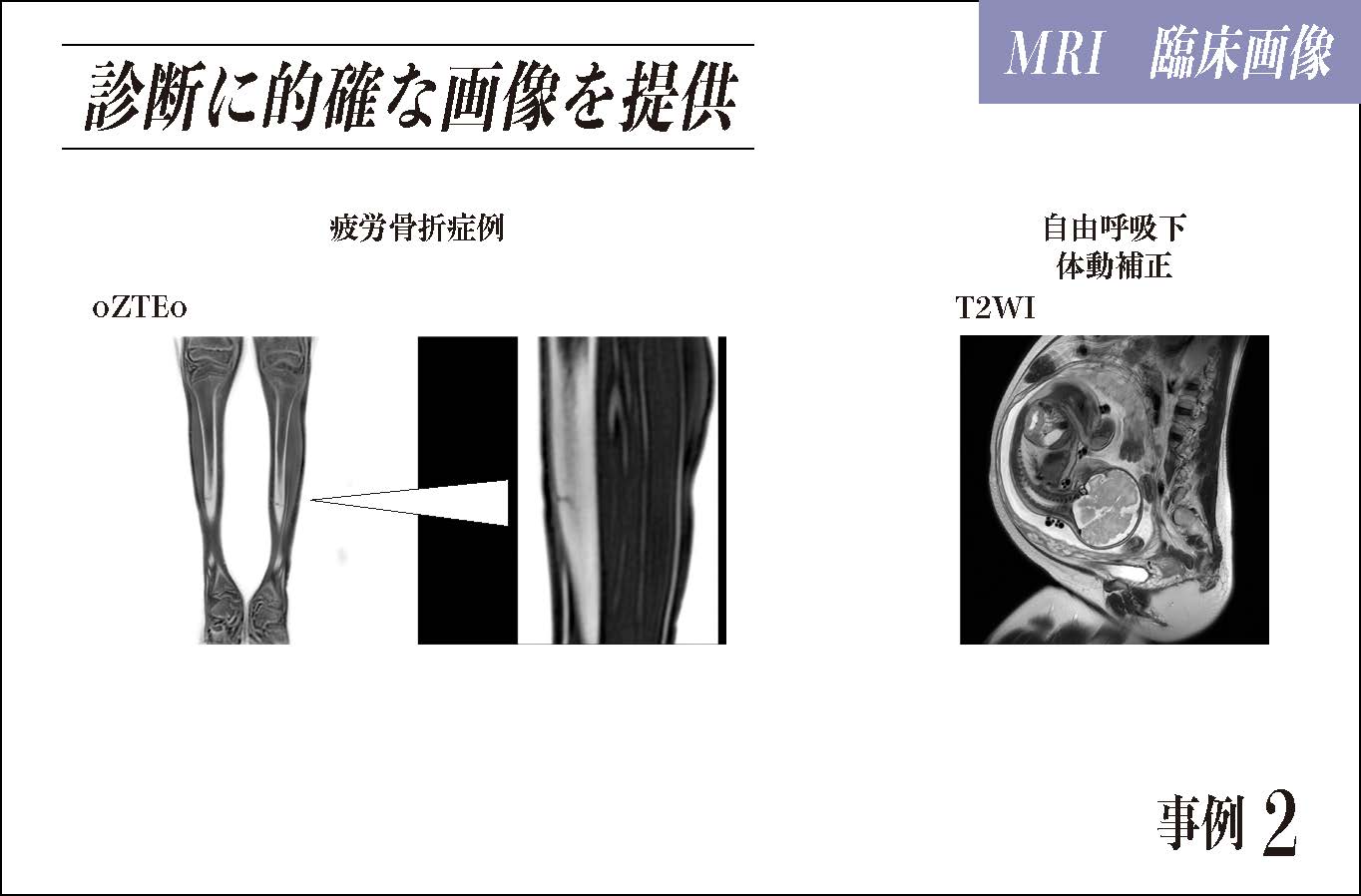 診断に的確な画像を提供 疲労骨折症例 自由呼吸下体動補正
