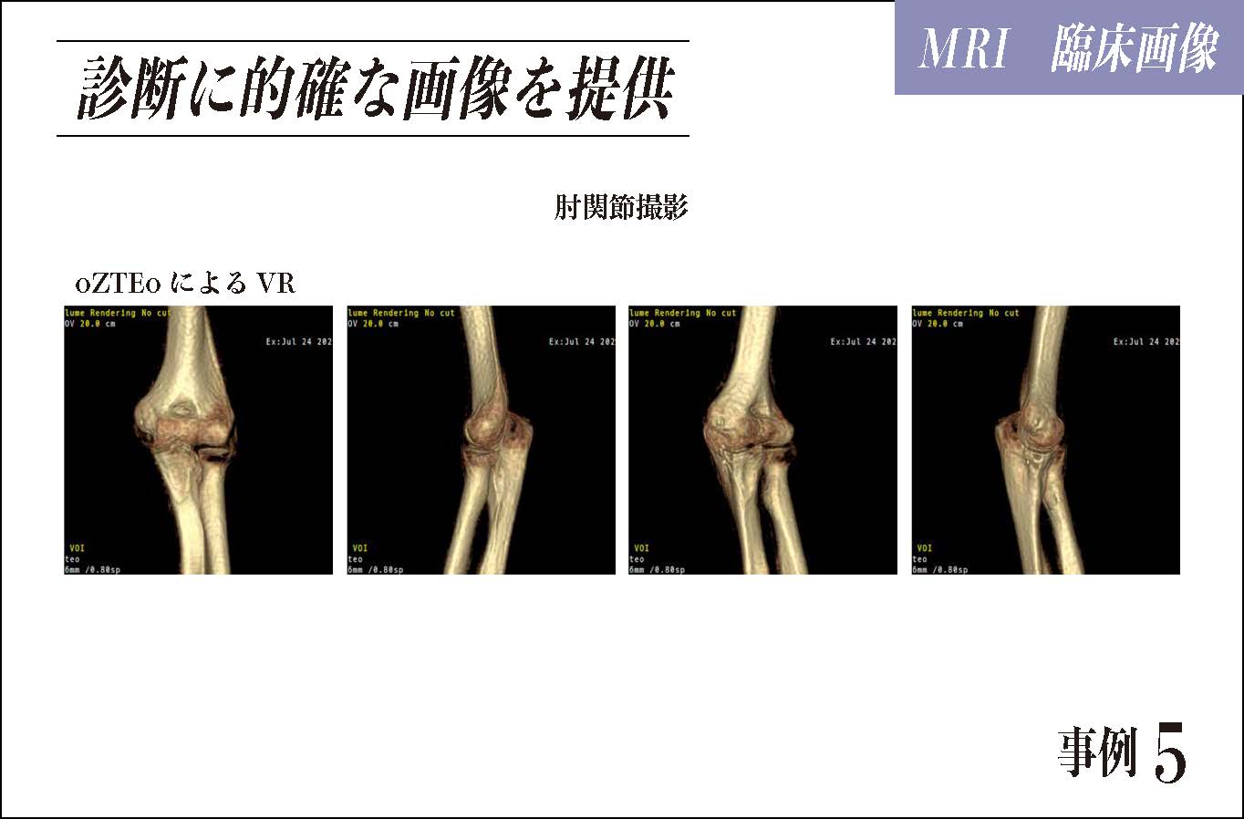 診断に的確な画像を提供 肘関節撮