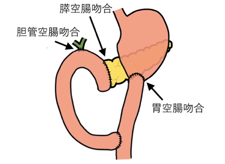 頭十二指腸切除②