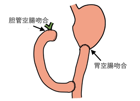 膵全摘②