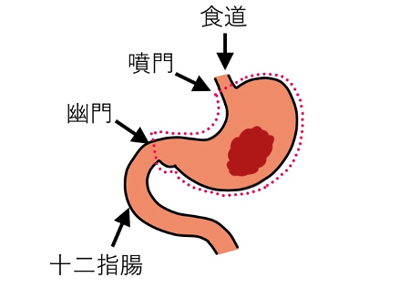胃全摘術①