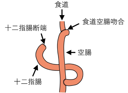 胃全摘術②