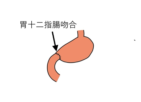 幽門側胃切除術②