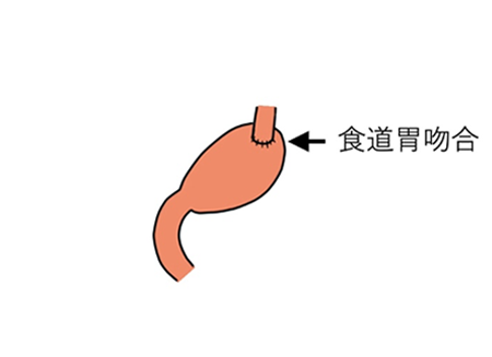 噴門側胃切除術②