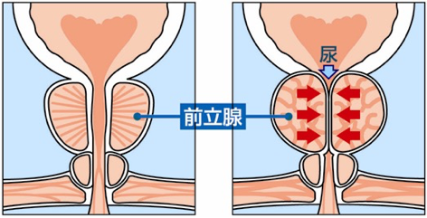 前立腺肥大症