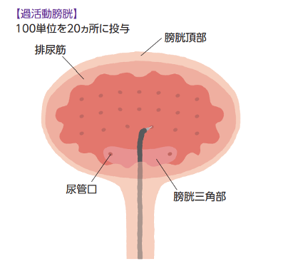 ボツリヌス毒素の膀胱粘膜下への注入